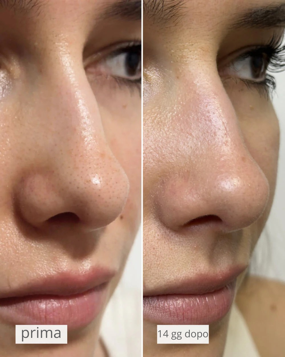 NOSE PATCHES